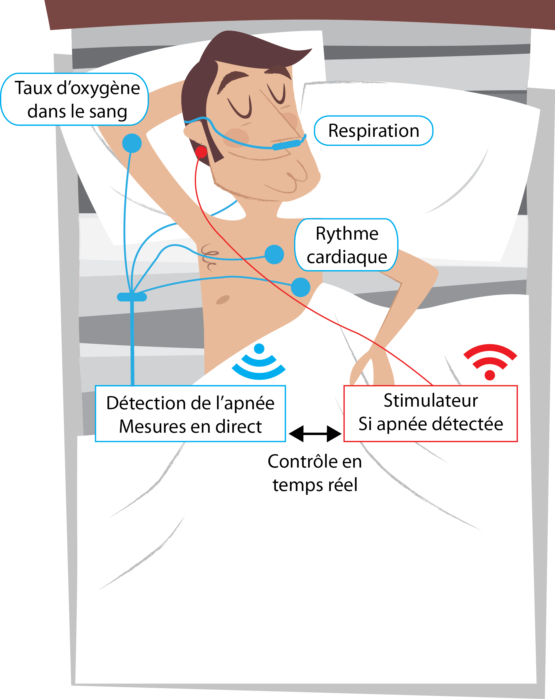 Du nouveau dans la lutte contre l’apnée du sommeil?
